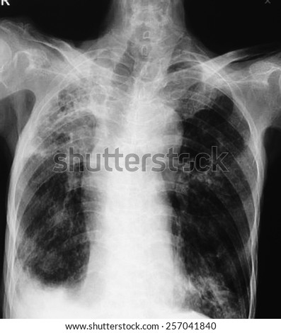 Pulmonary Tuberculosis . Chest X-Ray : Right Lung Atelectasis And ...