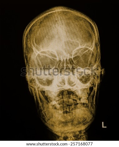 film x-ray Skull AP : show normal human\'s skull