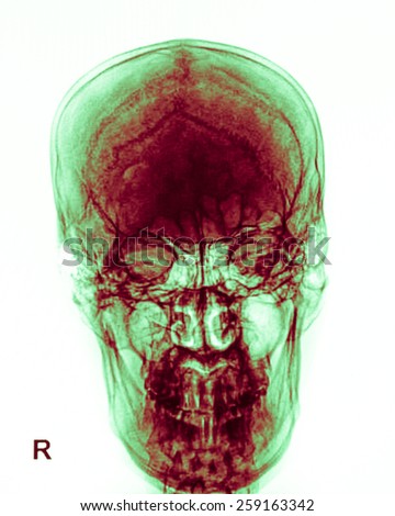 Human skull X-ray image isolated on white
