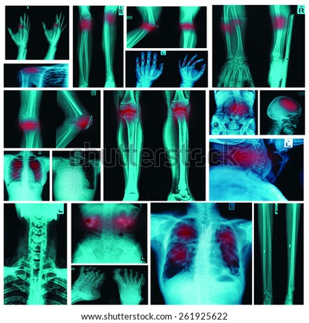 Collection X-ray multiple organ and arthritis at multiple joint (Rheumatoid,Gout)