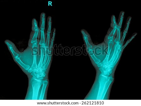 xray of a hand with broken finger