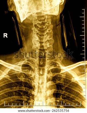 X-ray image of neck cervical spine