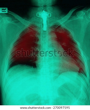 film chest X-ray PA upright : show human chest with tracheotomy tube