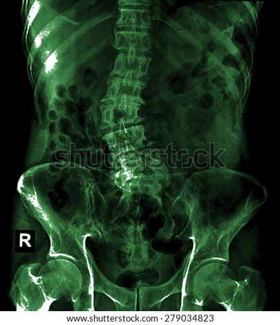 Scoliosis film x-ray lumbar spine AP