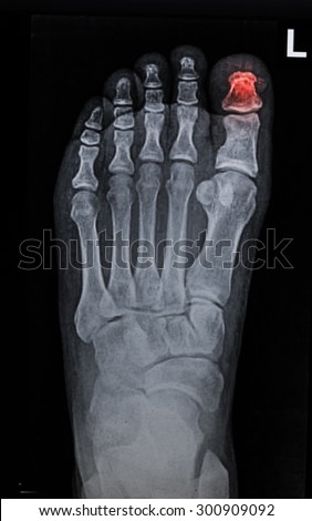 film x-ray show broken foot