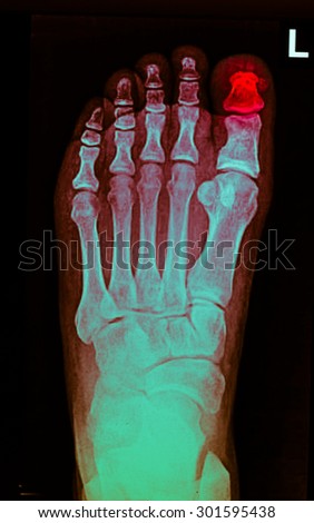 film x-ray show broken foot