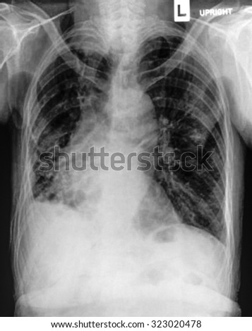 Chest X-Ray Film Showing Perihilar Infiltration, Pneumonia Or Lung ...