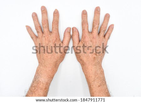 Age spots on hands of Asian elder man. They are brown, gray, or black spots and also called liver spots, senile lentigo, solar lentigines, or sun spots. Isolated on white background.