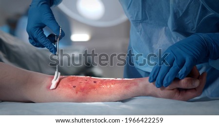 Surgeons team working with burn wound on arm of patient in operating room. Close up of medics disinfecting burn wound of patient in operating room