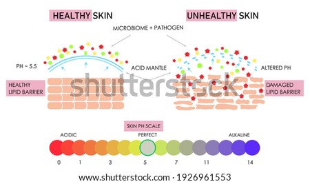 Vector scientific scheme of healthy and damaged skin building, comparison. Acidic alkaline ph scale impact on lipid barrier acid mantle. Microbiome protection film layer. Anatomical info graphic poster