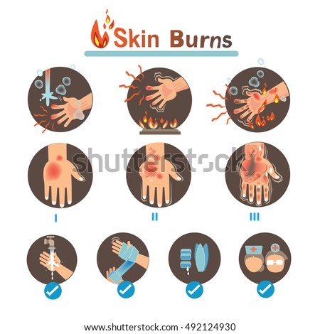 Degree Burns and Thermal Burns Treatment,Vector illustrations | Free ...