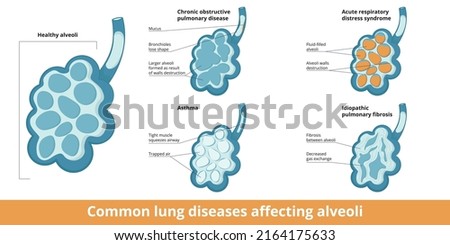 Common alveoli damages. Differences between changes caused by lung diseases: chronic obstructive respiratory disease, asthma, acute respiratory distress syndrome and idiopathic pulmonary fibrosis. Photo stock © 