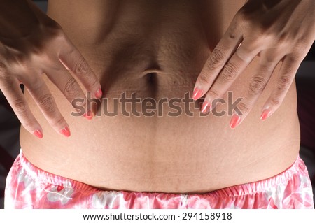 Stretch marks on stomach of young women after childbirth