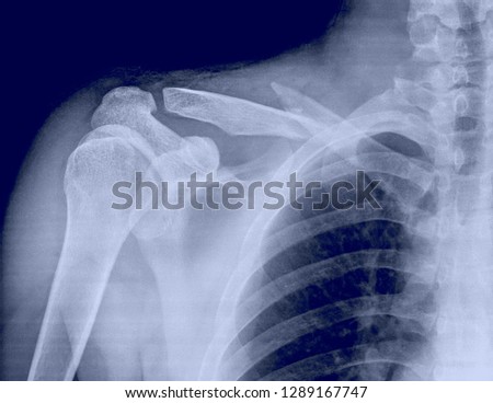 broken collarbone sleeping broken collarbone symptoms