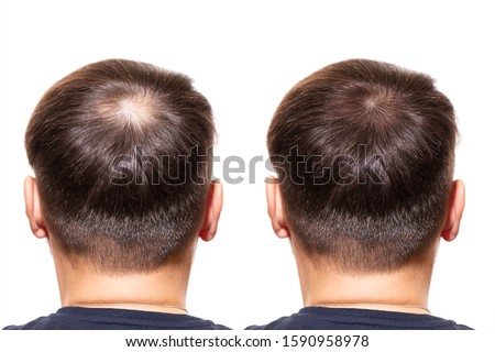 hair loss. Care Concept. transplantation hair. men view from the back, comparison of hair before and after transplantation. bald head.  baldness treatment. medicine. thick healthy hair. head          
