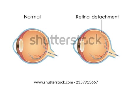Retinal detachment, eye disease, Flat vector illustration medicine