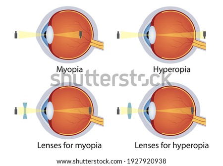 Hyperopia and myopia corrected by lens. Concept of eyes defect. Correction of various eye vision disorders by lens.
