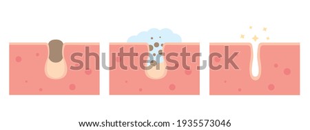 Cleaning clogged pores process flat illustration. Blackheads removal, skin cleaning foam, skincare. Can be used for topics like cosmetology, cosmetics. Shrinking and minimizing face pores concept Foto stock © 