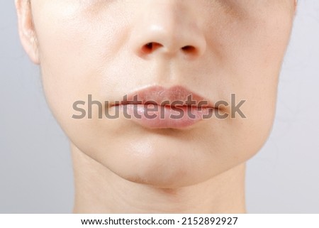 Closeup of down part of females face of suffering from strong tooth pain. Consept of the cheek swelling, teeth problem: gumboil, flux, dental health and care. 1 day after surgery. Stockfoto © 