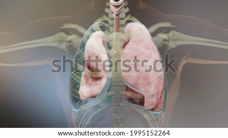 3d Illustration of Pneumothorax, Normal lung versus collapsed,  symptoms of pneumothorax, pleural effusion,  empyema, complications after a chest injury, air in the pleural space, 3d Render Photo stock © 