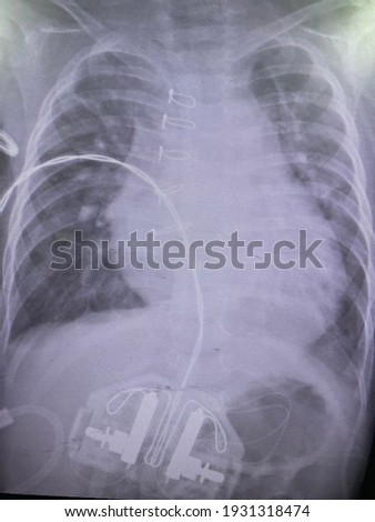 Film x-ray show pulmonary congestion left pleural effusion  and atelectasis with right infiltration for medical concept and medical technology concept  Photo stock © 