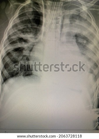 Film x-ray show right and left lung infiltration with effusion at left lung with air bronchogram at left upper lung for medical and technology concepts  Photo stock © 