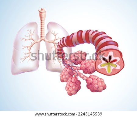 3D illustration of trachea and air sacs in human lungs highlighting bronchitis and filled with phlegm. Medical, educational and commercial use