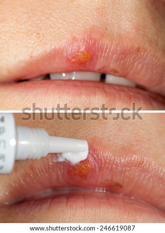 cold sore on mouth to be treatment ointment