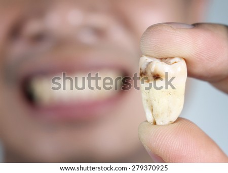 Man show decayed tooth in hand