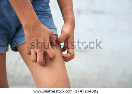 Women are scratching the thigh, Itching thigh, tching leg, Healthcare concept.                Foto stock © 