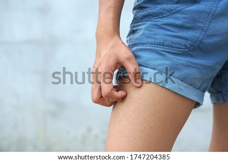 Women are scratching the thigh, Itching thigh, tching leg, Healthcare concept.                Foto stock © 