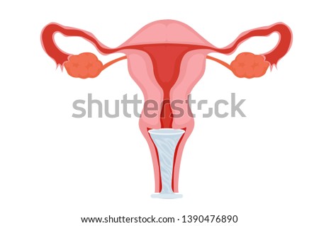 Female condom in the uterus