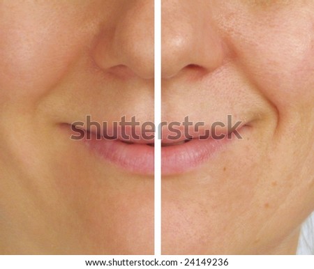 Correction of wrinkles on half of face