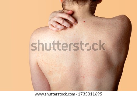 Allergic dermatitis on the skin of a woman's back. Skin disease. Neurodermatitis disease, eczema or allergy rash. Healthcare and Medical. Desquamation of the skin. Copy space for text Foto d'archivio © 