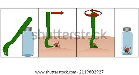 Illustration of special tweezers for removing ticks. Instructions for removing a tick with special tweezers. Tick ​​bite. Placing the tick in a container. Vector illustration Foto stock © 