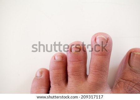 human foot and ingrown nail, onychocryptosis