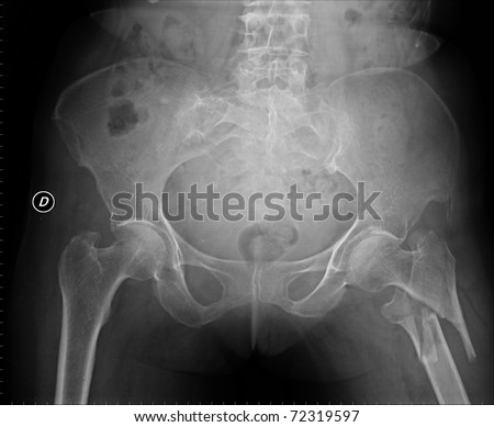 Broken Hip Of A Woman Stock Photo 72319597 : Shutterstock
