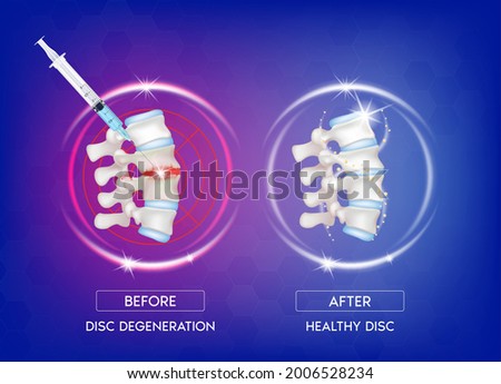 Before and after spinal treatment with syringe needle to degenerative disc and herniated disc, normal backbone. Skeleton x ray scan concept. Human vertebrae anatomy medical. 3D Vector.