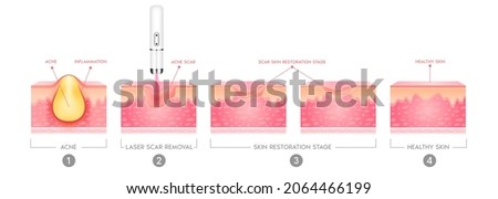Acne scar vascular laser treatment inflammation associated with pimples. On a white background. The structure of the skin acne scar. Medical beauty skin care concept. 3D vector illustration. Imagine de stoc © 