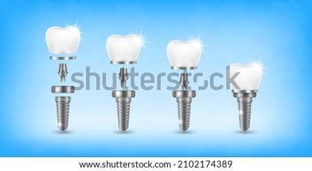 Tooth and teeth implant for stomatology set. Implant structure models. Screw denture orthodontic implantation. stomatology clinic concept. Realistic isolated 3D vector ​illustration. Foto stock © 