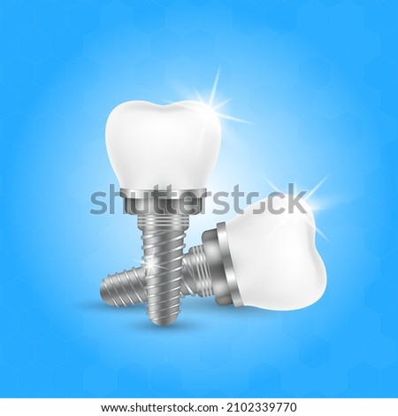 Tooth and teeth implant for stomatology. Implant structure models. Screw denture orthodontic implantation. stomatology clinic concept. Realistic isolated 3D vector ​illustration. Stock foto © 