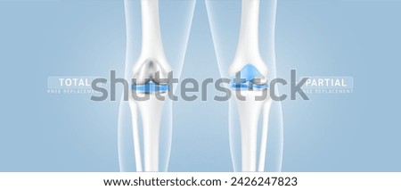 Knee replacement surgery total or partial implant for treatment relieve arthritis, after joint damaged. X Ray scan leg bone and cartilage. Medical health care science technology concept. Vector EPS10.