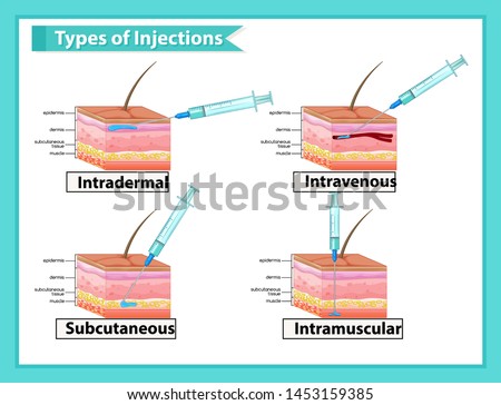 Scientific medical illustration of types of injections illustration