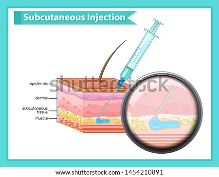 Scientific medical illustration of subcutaneous injection illustration