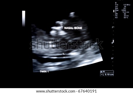 first trimester ultrasound baby xray of Fraternal twin face