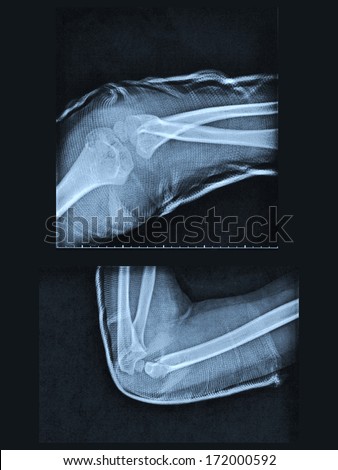 X ray of broken arm with humerus fracture