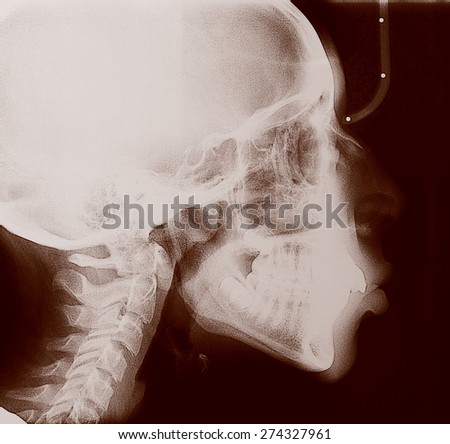 Vintage looking Medical X ray imaging of human skull, teeth and spine of a child