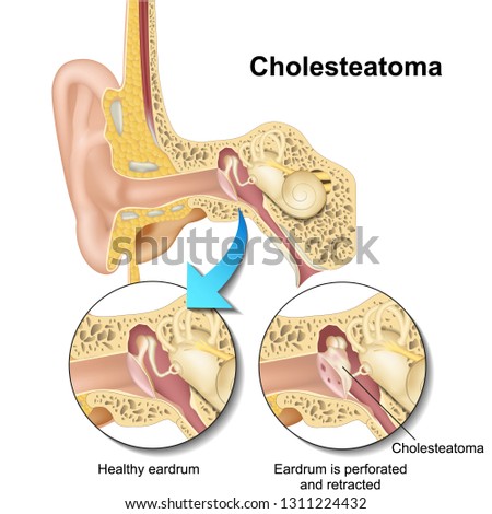 Cholesteatoma human ear anatomy vector illustraton on white background Stock fotó © 