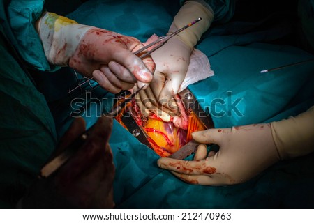 Surgery for coronary artery disease using off-pump technique (OPCAB)