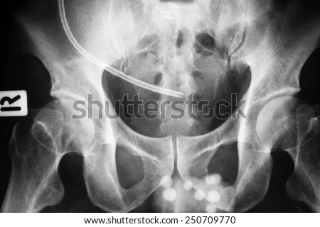 Pelvic X-ray image